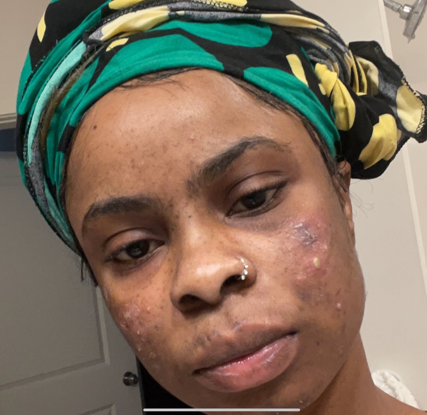 Sora super effective acne dart spot pimple set of three