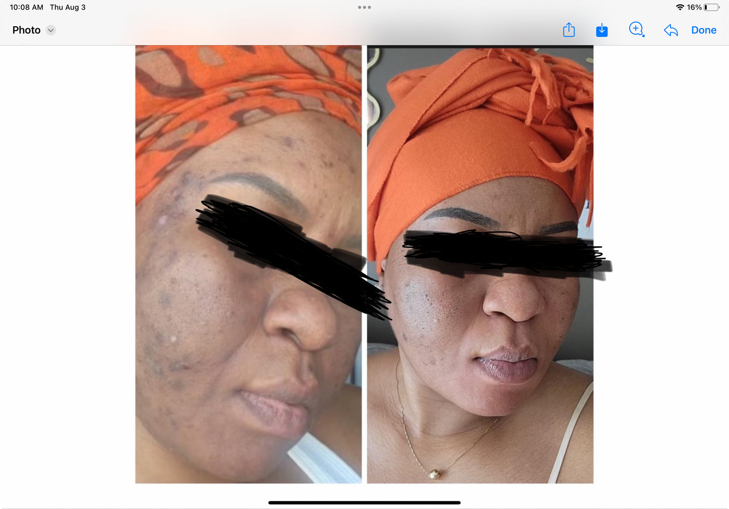 Sora super effective acne dart spot pimple set of three